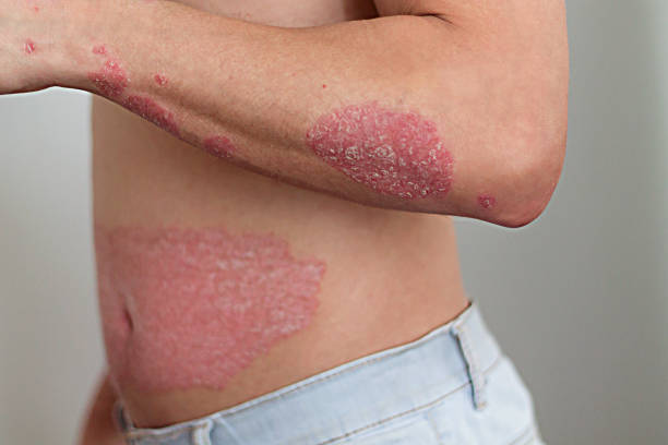 Psoriasis 